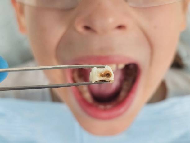 Best Knocked-Out Tooth (Avulsed Tooth) Treatment in Philipsburg, PA